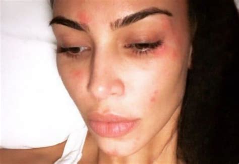 Kim Kardashian Shares New Pic Of Psoriasis As She Continues To Battle