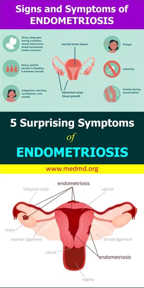 5 Surprising Symptoms Of Endometriosis Endometriosis Symptoms