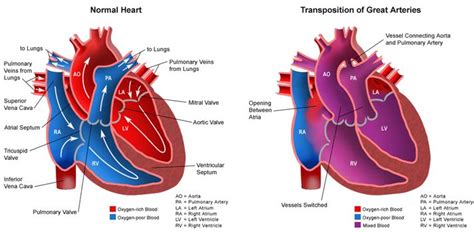 Pin On Congenital Heart Defects Chd Awareness