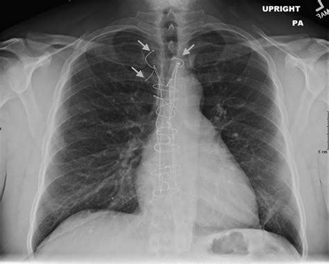 Sternal Fracture X Ray