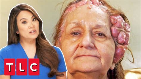 Woman Has Over 100 Cysts On Her Head Dr Pimple Popper This Is Zit