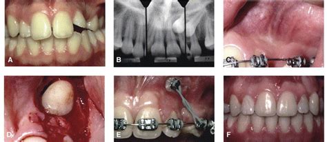 Surgical And Orthodontic Management Of Impacted Maxillary Canines