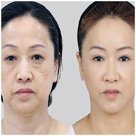 Forehead Lift Partners In Plastic Surgery