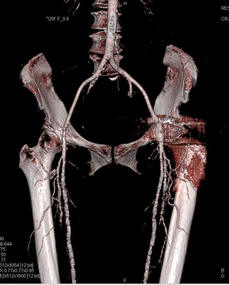 Ct Runoff With Pseudo Occlusion Left Femoral Artery Due To Artifact Off