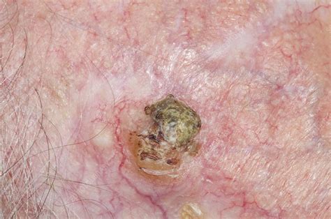 Squamous Skin Cancer On The Scalp Stock Image C Science