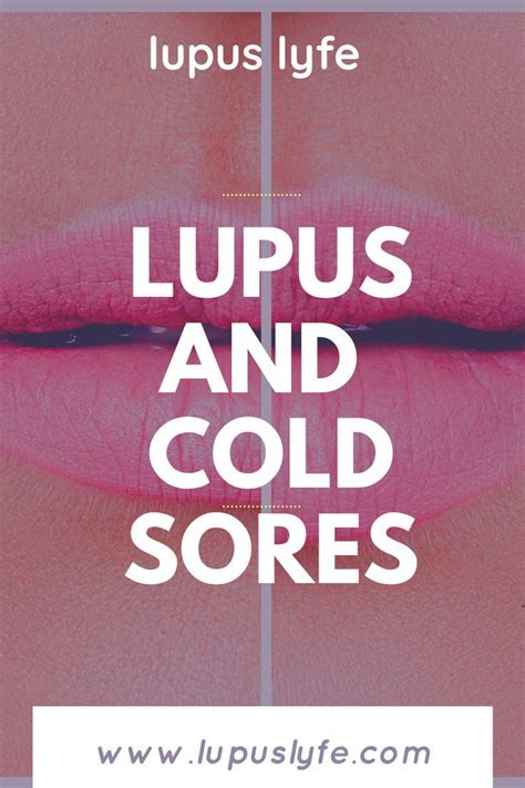 Lupus And Cold Sores In 2020 Cold Sore Soreness Lupus Flare
