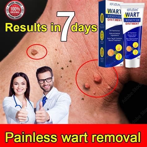 Sefudun Original Painless Wart Remover Cream Mole Remover Warts