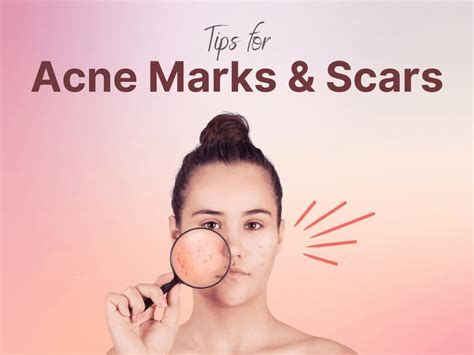Acne Scars And Marks 6 Tips That You Must Follow