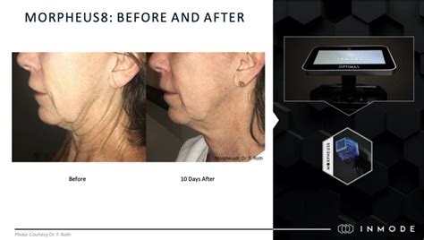 Inmode Morpheus 8 Facial Contouring Before And After Pics New