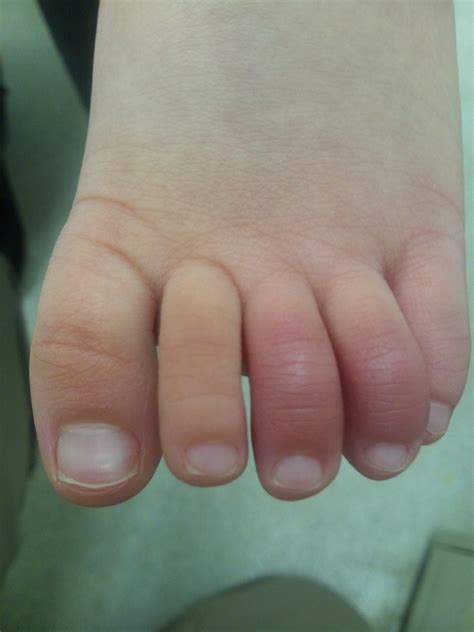 足 の 親指 腫れる | 足の親指が腫れています