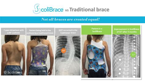 The Most Effective Scoliosis Brace In Tempe Az