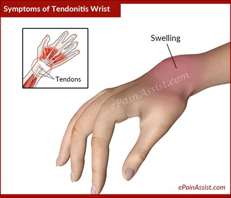 Picture Of Forearm Tendons Wrist Joint Tendonitiscausessymptoms