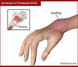 Medical Treatment For Tendonitis