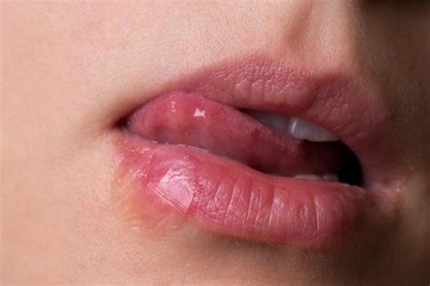 Stages Of Oral Herpes Livestrongcom