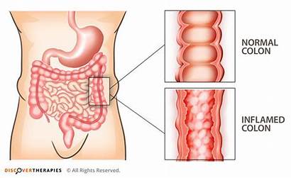 Colitis Bowel Between Difference Irritable Syndrome Intestine