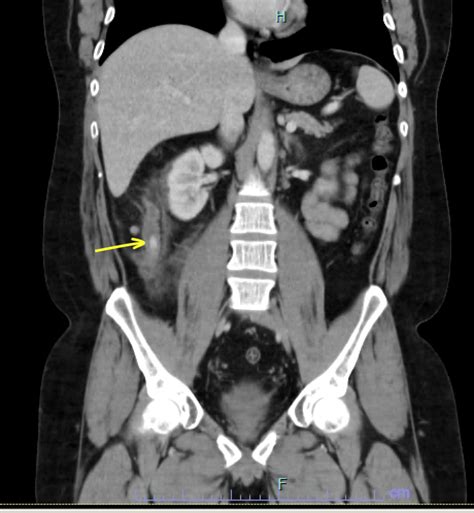Ct Scan Abdominal Pelvis Showing A Non Complicated Acute Appendicitis