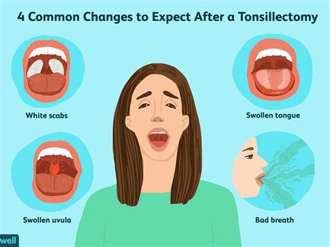 Tonsil Removal Before And After