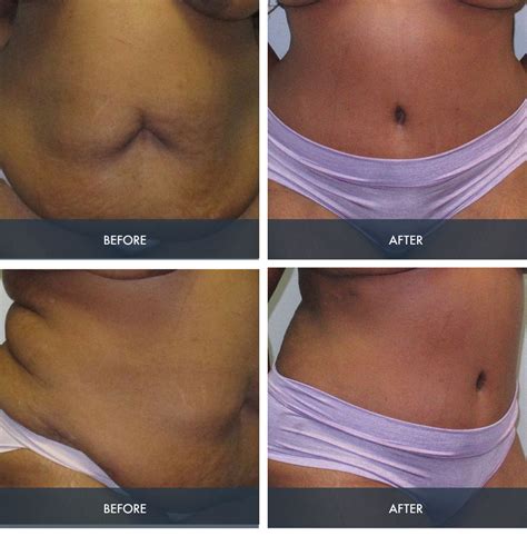 Tummy Tuck Before After Gallery Houston Pearland Suncoast Plastic