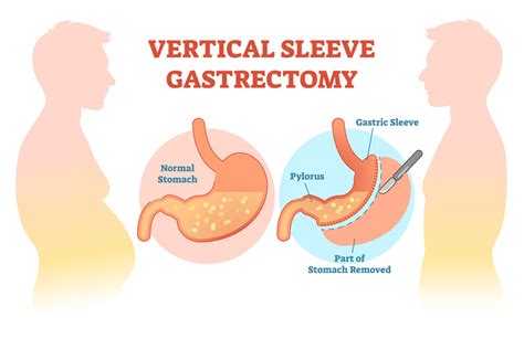 A Basic Guide To Understanding The Sleeve Gastrectomy Procedure