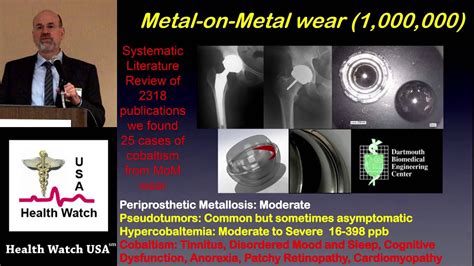 Adverse Events From Hip Implants Including Cobalt Poisoning Youtube