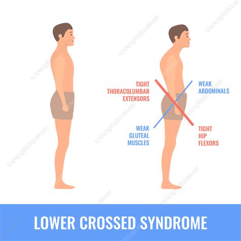 Lower Crossed Syndrome Conceptual Illustration Stock Image F035 0223 Science Photo Library