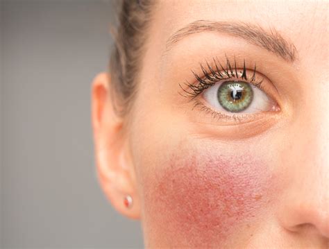 What Are The Biggest Triggers Of Rosacea