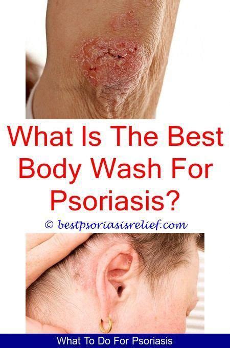 Psoriasiscure Home Remedies For Scalp Psoriasis Scales Psoriasis Sun