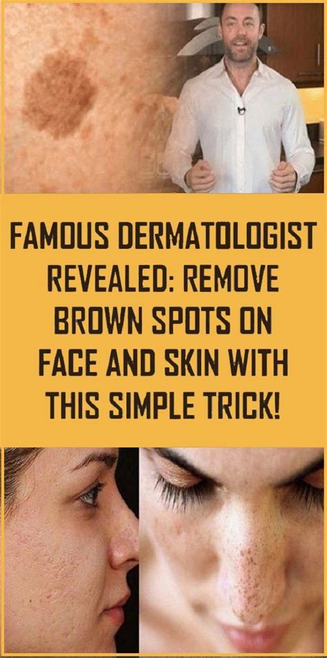 Get Rid Of The Brown Marks On Your Skin With This Simple Trick Health And Beauty Tips Spots