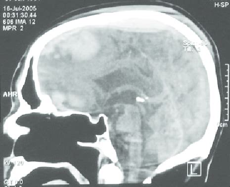 The Initial Ct Scan Sagittal View The Scan Shows The Vertex Epidural Download Scientific