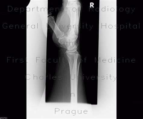 Radiology Case Visi Volar Intercalated Segment Instability