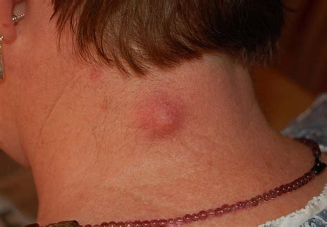 Lump On Neck Causes And Pictures Ckamgmt Com