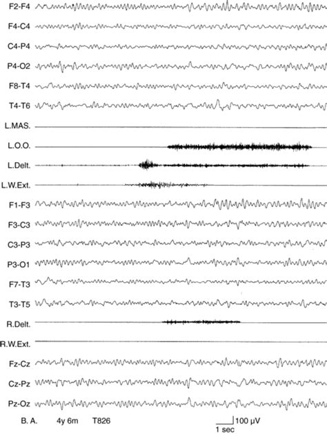Cortical Myoclonus And Epilepsy Overlap And Differences Neupsy Key