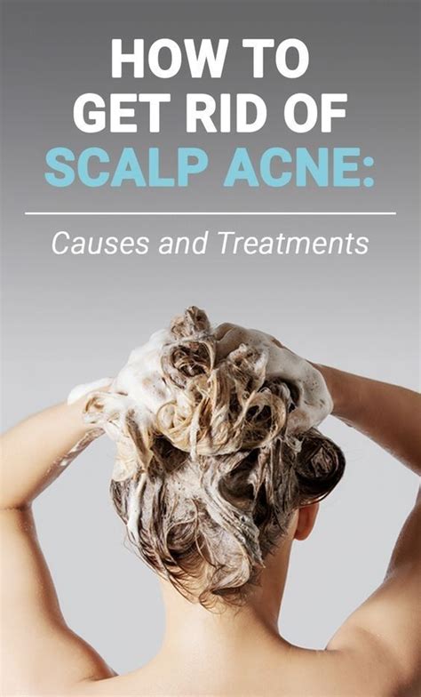 Scalp Pimples What Causes Them And How To Treat Them Scalp Acne