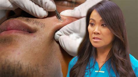 10 Time S Dr Pimple Popper Had Things Go Horribly Wrong Youtube
