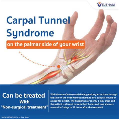 Non Surgical Treatment Option For Carpal Tunnel Syndrome Vejthani