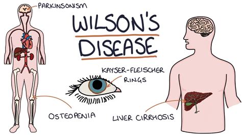 Symptoms Of Wilsons Disease Wilsons Healthresource4u Diseases