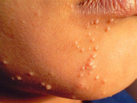 Baby und kleinkind häufig betroffen. Molluscum Contagiosum in Children. Causes, symptoms ...