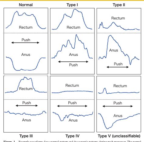 Figure 1 From Are There Sex Differences In Defecation Patterns In Patients With Defecation