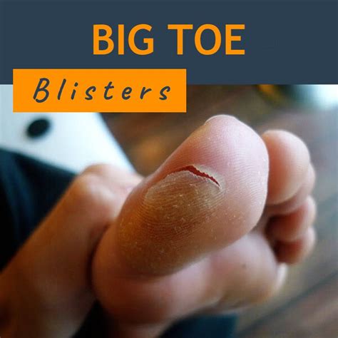 Big Toe Blisters Types Causes And Prevention Blister Prevention