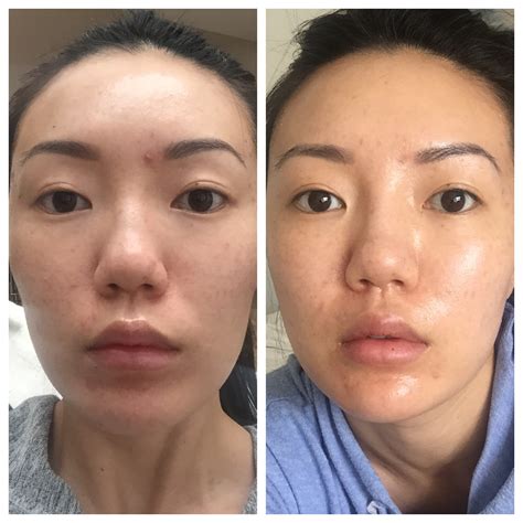 My Perioral Dermatitis Skincare Journey Month 3 Skincare Routine