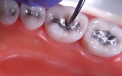 Amalgam Vs Composite The Skinny On Dental Fillings