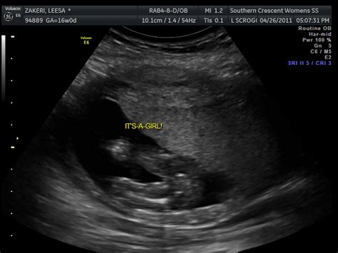 Meeshin Around 16 Week Ultrasound Reveals A Girl