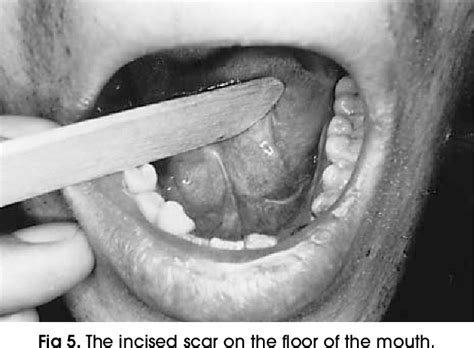 Figure 5 From Intraoral Removal Of The Submandibular Gland A New