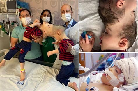 Conjoined Twins Born With Fused Brains Separated After 27 Hour Surgery