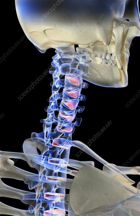 Having pain under or near your shoulder blade—the triangular bone that forms the back of your a herniated disc in the cervical spine (neck) occurs when a disc's outer layer (annulus fibrosus) tears us department of health and human services, national heart, lung, and blood institute website. The bones of the neck - Stock Image - F002/0686 - Science Photo Library