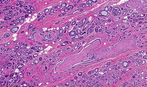 pathology outlines adenoid cystic carcinoma