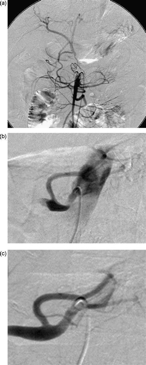 Celiac Artery Stenosisocclusion Treated By Interventional Radiology
