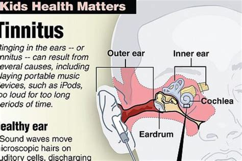 Tinnitus Symptoms And Causes Mayo Clinic Atelier Yuwaciaojp