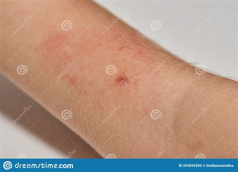 Insect Bite On Arm Of Child Stock Photo Image Of Dermatology Medical