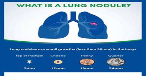 What Is A Lung Nodule Infographic Infographics